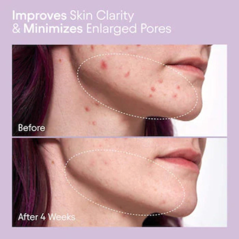 Alpyn | Pore Perfecting - Liquido Exfoliante | 2% Bha  120ml Todo Tipo De Piel Día/noche