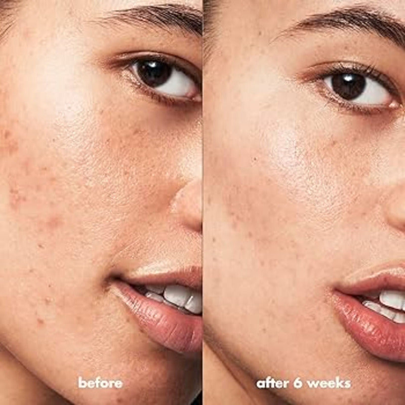 Elf | Gel Para Acné, Ac Salicilico, Acne Fighting Spot Gel Acneica Día/noche