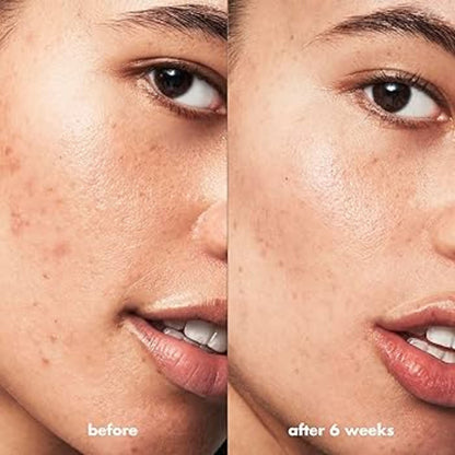 Elf | Gel Para Acné, Ac Salicilico, Acne Fighting Spot Gel Acneica Día/noche