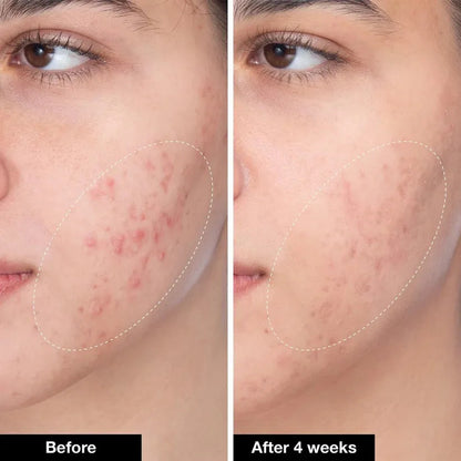Innbeauty Project Clear It Serum Antiacné Acneica Día/noche