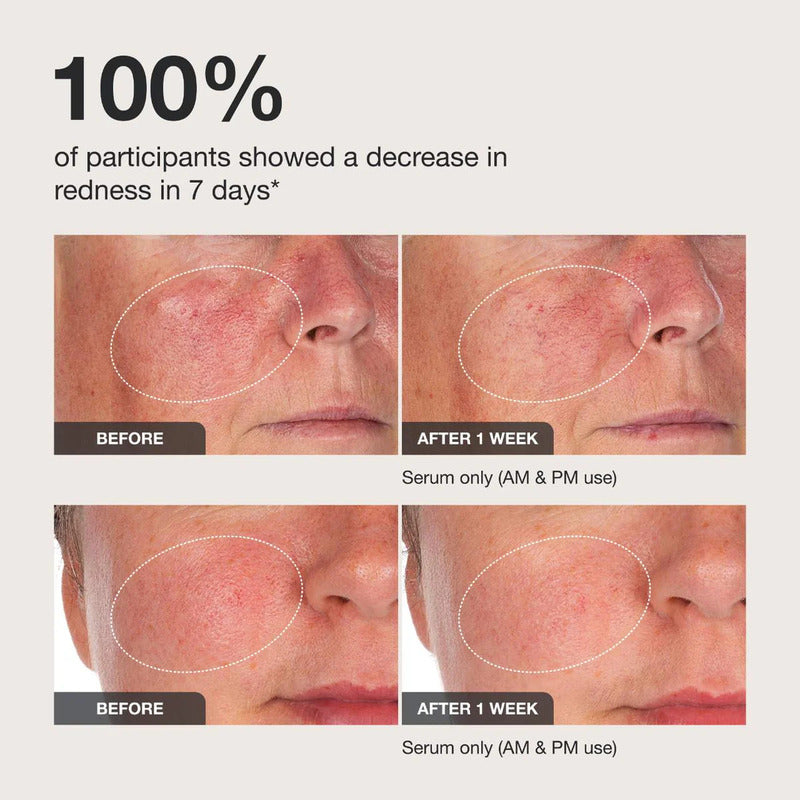 Innbeauty Project | Suero Para Rojeces - Calm The Red Down Sensible Día/noche
