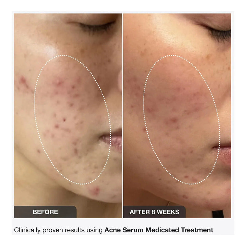 Innbeauty Project Clear It Serum Antiacné Acneica Día/noche