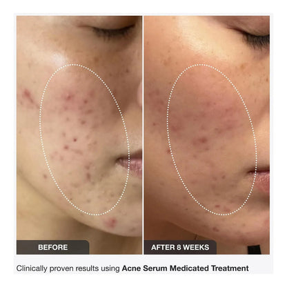 Innbeauty Project Clear It Serum Antiacné Acneica Día/noche